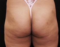 Liposuction After Photo by Richard Sadove, MD; Gainesville, FL - Case 22051