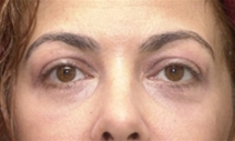 Eyelid Surgery After Photo by Richard Sadove, MD; Gainesville, FL - Case 22052