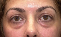 Eyelid Surgery Before Photo by Richard Sadove, MD; Gainesville, FL - Case 22052