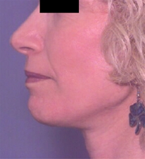 Facelift After Photo by Richard Sadove, MD; Gainesville, FL - Case 22518