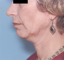 Facelift Before Photo by Richard Sadove, MD; Gainesville, FL - Case 22518
