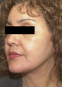 Facelift After Photo by Richard Sadove, MD; Gainesville, FL - Case 22520