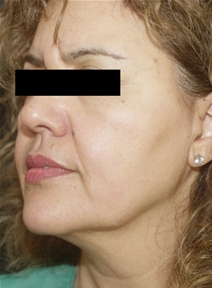 Facelift Before Photo by Richard Sadove, MD; Gainesville, FL - Case 22520