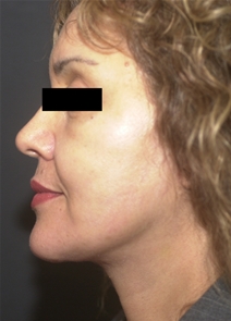 Facelift After Photo by Richard Sadove, MD; Gainesville, FL - Case 22520