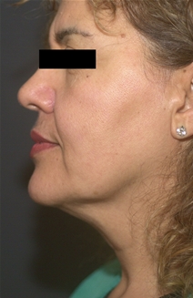 Facelift Before Photo by Richard Sadove, MD; Gainesville, FL - Case 22520