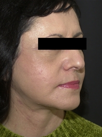 Facelift After Photo by Richard Sadove, MD; Gainesville, FL - Case 22521