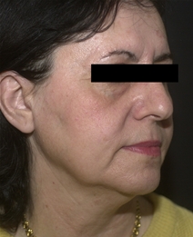 Facelift Before Photo by Richard Sadove, MD; Gainesville, FL - Case 22521