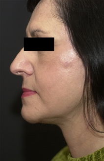 Facelift After Photo by Richard Sadove, MD; Gainesville, FL - Case 22521
