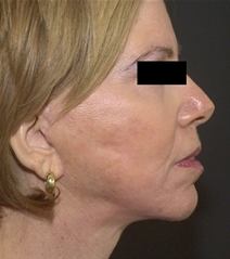 Facelift After Photo by Richard Sadove, MD; Gainesville, FL - Case 22530