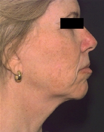 Facelift Before Photo by Richard Sadove, MD; Gainesville, FL - Case 22530