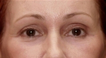 Eyelid Surgery After Photo by Richard Sadove, MD; Gainesville, FL - Case 22549