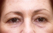 Eyelid Surgery Before Photo by Richard Sadove, MD; Gainesville, FL - Case 22549