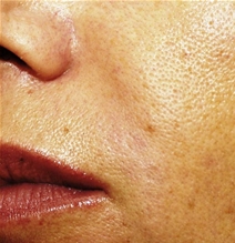 Dermal Fillers After Photo by Richard Sadove, MD; Gainesville, FL - Case 22574