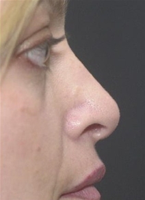 Rhinoplasty After Photo by Richard Sadove, MD; Gainesville, FL - Case 22597