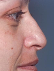 Rhinoplasty Before Photo by Richard Sadove, MD; Gainesville, FL - Case 22597
