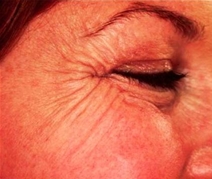 Botulinum Toxin Before Photo by Richard Sadove, MD; Gainesville, FL - Case 23425