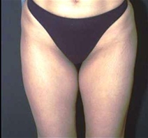 Liposuction After Photo by Richard Sadove, MD; Gainesville, FL - Case 23510