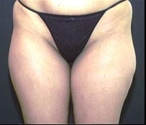 Liposuction Before Photo by Richard Sadove, MD; Gainesville, FL - Case 23510