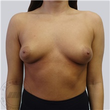 Breast Augmentation Before Photo by Mathew Plant, MD; Toronto, ON - Case 42939