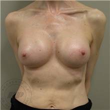 Breast Augmentation After Photo by Mathew Plant, MD; Toronto, ON - Case 42940