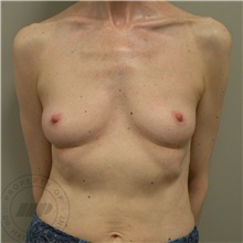 Breast Augmentation Before Photo by Mathew Plant, MD; Toronto, ON - Case 42940