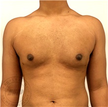 Male Breast Reduction After Photo by Mathew Plant, MD; Toronto, ON - Case 42945