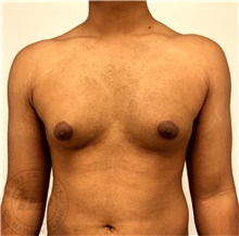 Male Breast Reduction Before Photo by Mathew Plant, MD; Toronto, ON - Case 42945