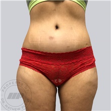Tummy Tuck After Photo by Mathew Plant, MD; Toronto, ON - Case 42946