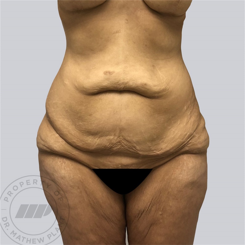 Tummy Tuck Before and After Photos by Mathew Plant, MD; Toronto, ON - Case  42946