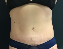 Tummy Tuck After Photo by James Rosing, MD, FACS; Newport Beach, CA - Case 29871