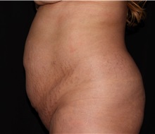 Tummy Tuck Before Photo by James Rosing, MD, FACS; Newport Beach, CA - Case 29871