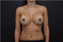 Breast Augmentation After Photo by James Rosing, MD, FACS; Newport Beach, CA - Case 37290