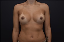 Breast Augmentation Before Photo by James Rosing, MD, FACS; Newport Beach, CA - Case 37290