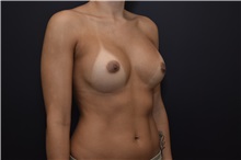 Breast Augmentation Before Photo by James Rosing, MD, FACS; Newport Beach, CA - Case 37290