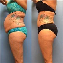 Tummy Tuck After Photo by Jason Petrungaro, MD, FACS; Munster, IN - Case 29917