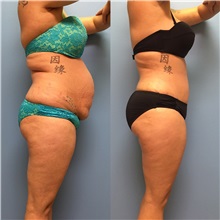 Tummy Tuck Before Photo by Jason Petrungaro, MD, FACS; Munster, IN - Case 29917