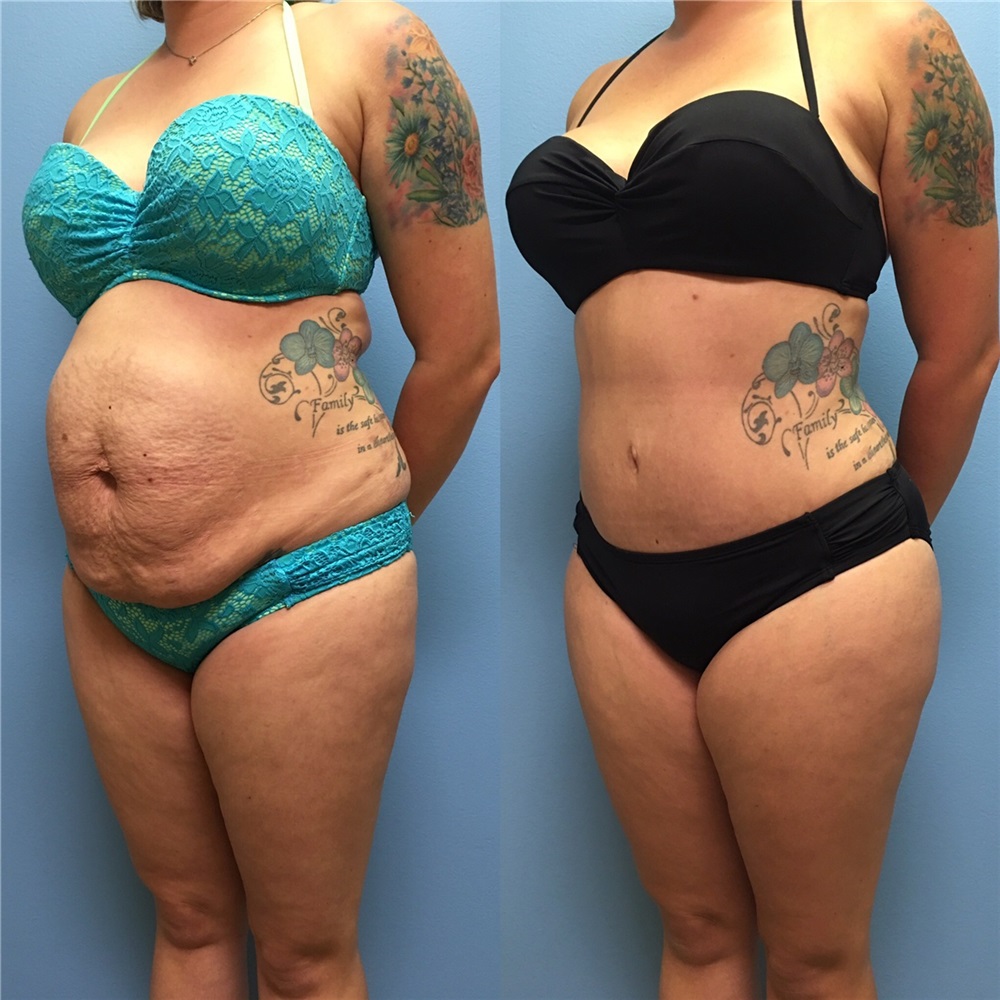 Tummy Tuck Before and After Photos by Jason Petrungaro, MD, FACS; Munster,  IN - Case 29917 | ASPS