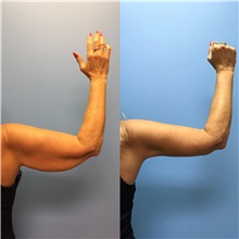Arm Lift After Photo by Jason Petrungaro, MD, FACS; Munster, IN - Case 31327