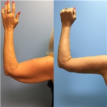 Arm Lift Before Photo by Jason Petrungaro, MD, FACS; Munster, IN - Case 31327