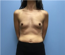 Breast Augmentation Before Photo by Jason Petrungaro, MD, FACS; Munster, IN - Case 31328