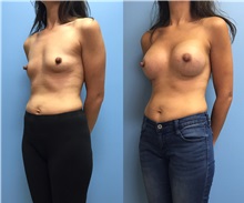 Breast Augmentation After Photo by Jason Petrungaro, MD, FACS; Munster, IN - Case 31328