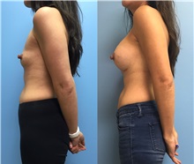 Breast Augmentation After Photo by Jason Petrungaro, MD, FACS; Munster, IN - Case 31328