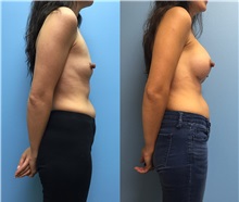 Breast Augmentation Before Photo by Jason Petrungaro, MD, FACS; Munster, IN - Case 31328