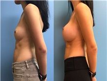 Breast Augmentation After Photo by Jason Petrungaro, MD, FACS; Munster, IN - Case 31329
