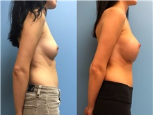 Breast Augmentation Before Photo by Jason Petrungaro, MD, FACS; Munster, IN - Case 31329