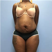 Tummy Tuck Before Photo by Jason Petrungaro, MD, FACS; Munster, IN - Case 31330