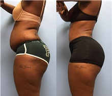 Tummy Tuck After Photo by Jason Petrungaro, MD, FACS; Munster, IN - Case 31330