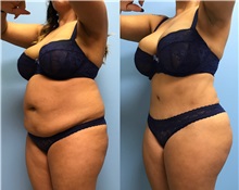 Tummy Tuck After Photo by Jason Petrungaro, MD, FACS; Munster, IN - Case 31332