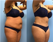 Tummy Tuck Before Photo by Jason Petrungaro, MD, FACS; Munster, IN - Case 31332