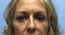 Eyelid Surgery After Photo by Jason Petrungaro, MD, FACS; Munster, IN - Case 31333